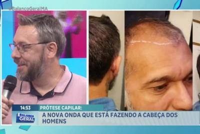 Vem Comigo: conheça a prótese capilar, tendência estética para disfarçar a calvície